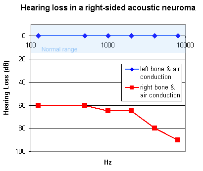 In acoustic neuroma the pure tone audiogram shows an ipsilateral sensorineural deafness.  This is a typical pure tone audiogram.