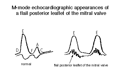 diagram of echo in flail posterior mitral leaflet.