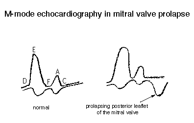 diagram of echo in mitral valve prolapse: prolapsing posterior leaflet of the mitral valve.