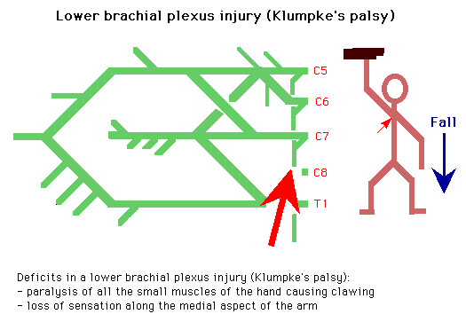 Klumpke's palsy.  Lower brachial plexus lesions involve C8 and T1. They are the result of traction on the arm in an abducted position - e.g. during a difficult labour; or at birth - Dejerine Klumpke's palsy.  The patient presents with a claw hand - the result of paralysis of the intrinsic hand muscles; sensory loss along the ulnar side of the hand and the forearm (first thoracic dermatome); and if the T1 root is affected, possibly, a Horner's syndrome from interruption of sympathetic innervation at that level.