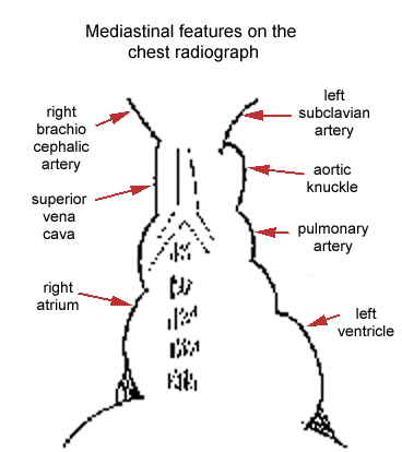 Chest X ray (radiographic) appearance of  the mediastinum, subclavian artery, aortic knuckle, pulmonary artery, left ventricle, right atrium, superior vena cava, brachiocephalic vein.