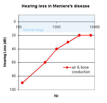 Meniere's disease is characterised by a low frequency sensorineural hearing loss.   This is a typical pure tone audiogram.