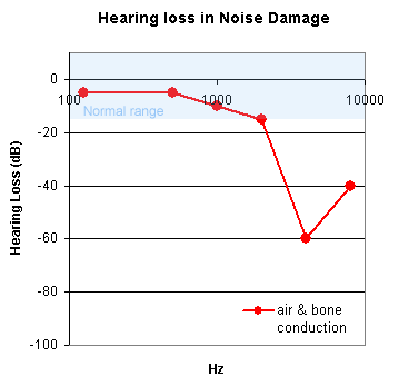 The audiogram in a patient with early noise-induced deafness demonstrates particular loss around 4000 Hz. With continued exposure to noise the sensitivity at 8000 Hz is lost as well.