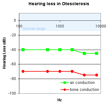 Otosclerosis and chronic otoitis media result in a mixed conduction and sensorineural deafness. 