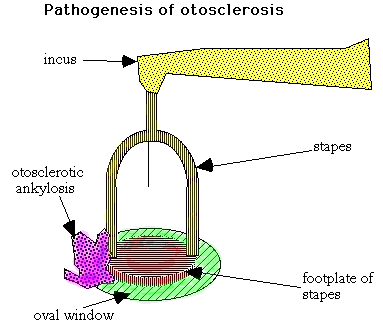 Typically, otosclerosis causes a progressive conductive deafness due to fixation of the stapes at the oval window; the ear drums are normal.