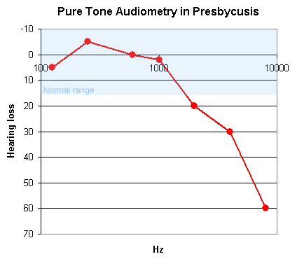 Presbycusis is the loss of high frequency sensivity with age. This is a representative  pure tone audiogram.